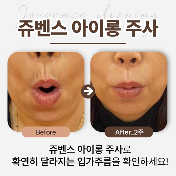 확연히 달라지는 입가주름을 확인하세요