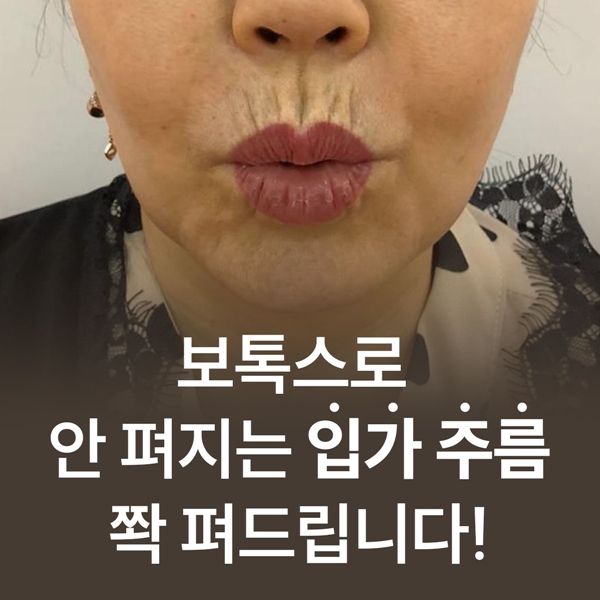 보톡스로 안펴지는 입가주름 쫙 펴드립니다